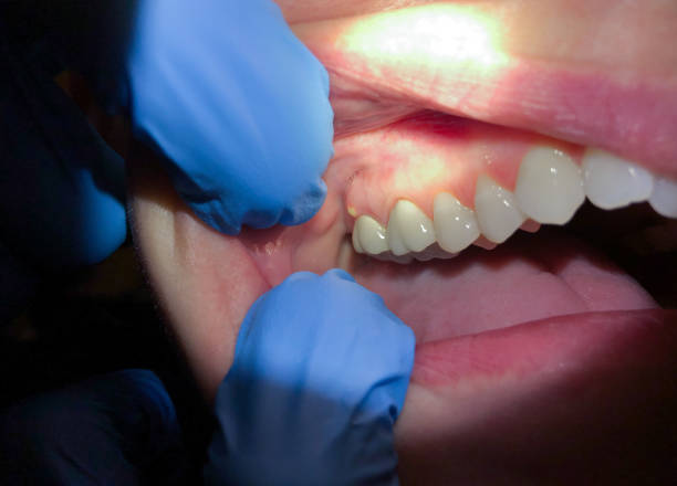 Best Urgent Tooth Repair  in San Lorenzo, CA