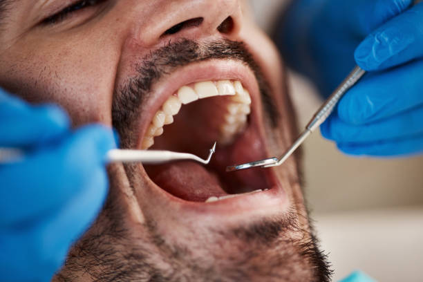 Best Chipped Tooth Repair Near Me  in San Lorenzo, CA