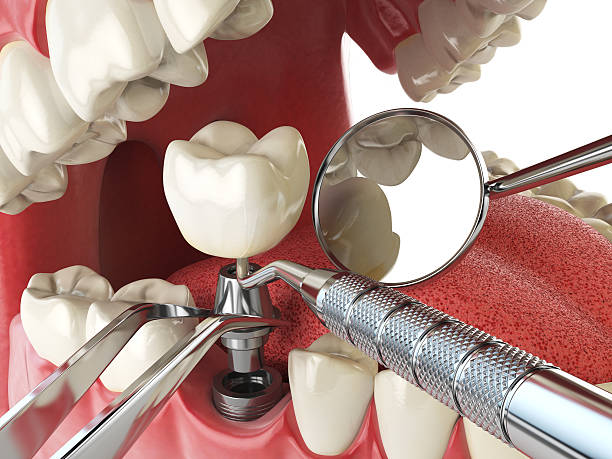 Best Cracked Tooth Emergency Dentist  in San Lorenzo, CA